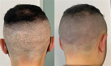 De Rol Van Voeding Bij Haartransplantatie