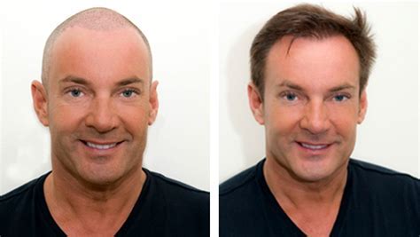 Haartransplantatie En Het Effect Van Stress