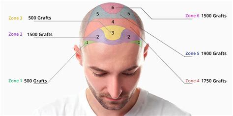 Haartransplantatie Kosten In Nederland: Een Overzicht