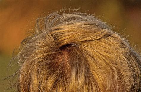 Wat Zijn De Meest Voorkomende Misvattingen Over Haartransplantatie?